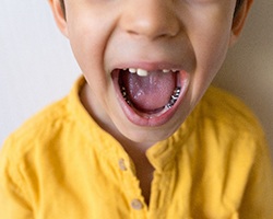 An AI image of a tooth getting silver diamine fluoride