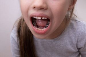 Girl’s mouth with crowns on the molars